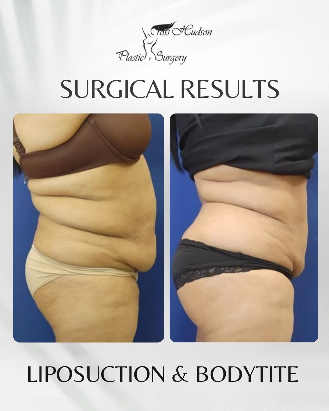 Before and after liposuction and body tite results showing abdominal contouring at Cross Hudson Plastic Surgery